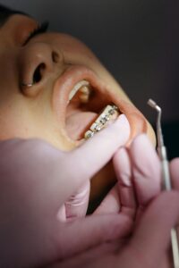 歯科医院でブラケット矯正の調整を受ける患者の口元。歯科医が器具でワイヤーを調整している様子。