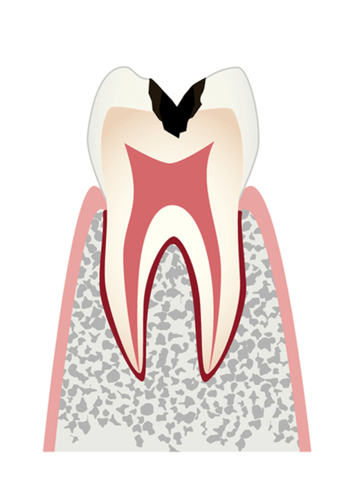 歯の内部（象牙質）まで進行したむし歯