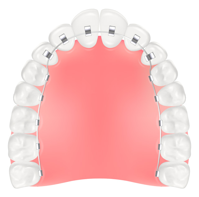 裏側（リンガル）矯正（舌側矯正）